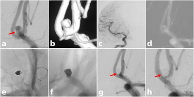 Endovascular Treatment of Ruptured Wide-Necked Anterior Communicating Artery Aneurysms Using a Low-Profile Visualized Intraluminal Support (LVIS) Device